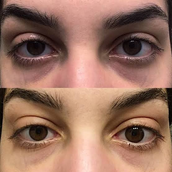سرم دورچشم کافئین اوردینری