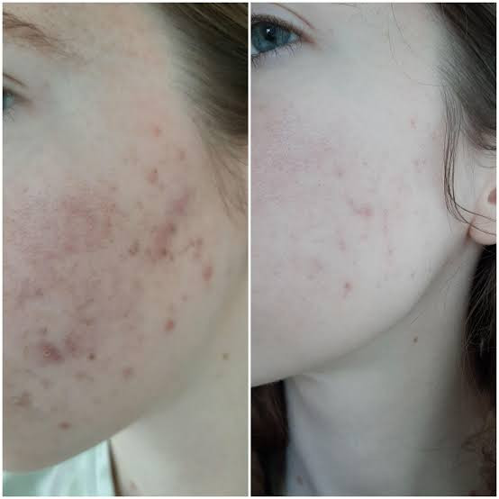 سرم لایه بردار aha/bha اوردینری