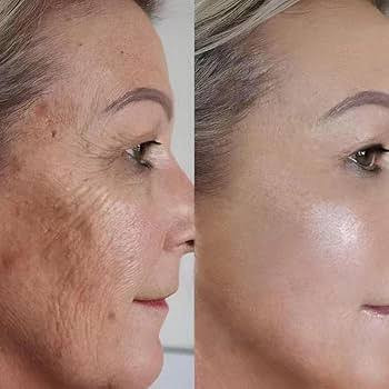 سرم لایه بردار aha/bha اوردینری