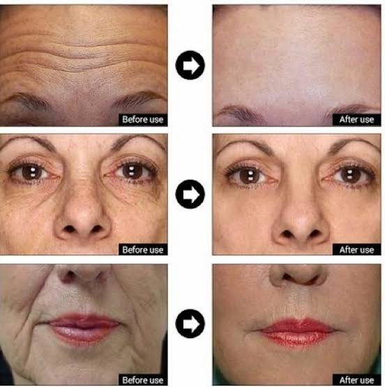 سرم ضدچروک ماتریکسیل اوردینری