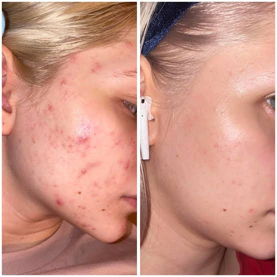 سرم لاکتیک اسید اوردینری