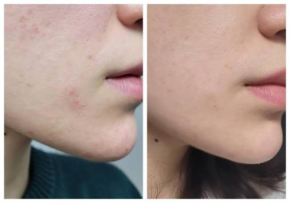 سرم لاکتیک اسید اوردینری